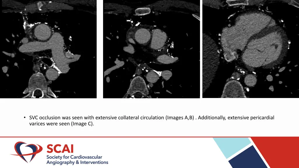 svc occlusion was seen with extensive collateral