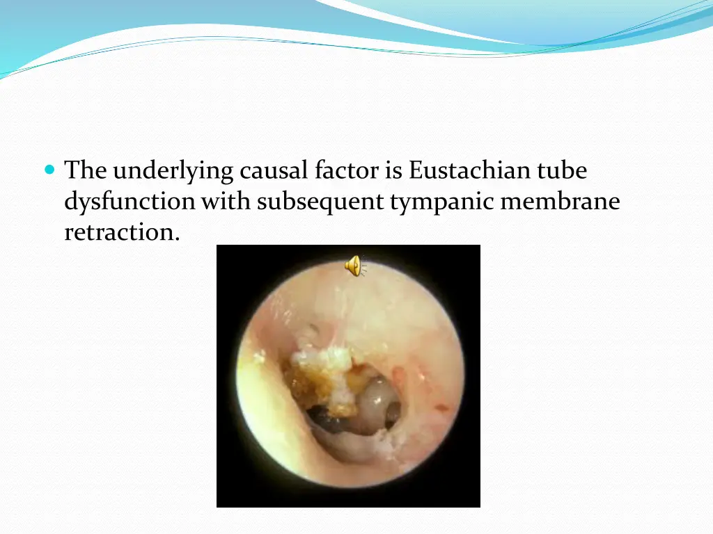 the underlying causal factor is eustachian tube