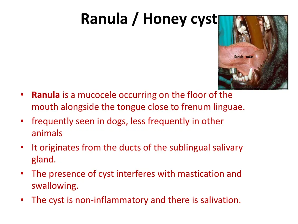 ranula honey cyst