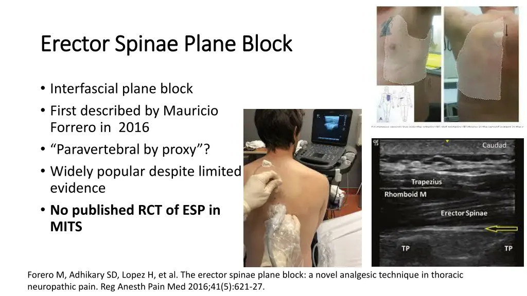 erector spinae plane block erector spinae plane