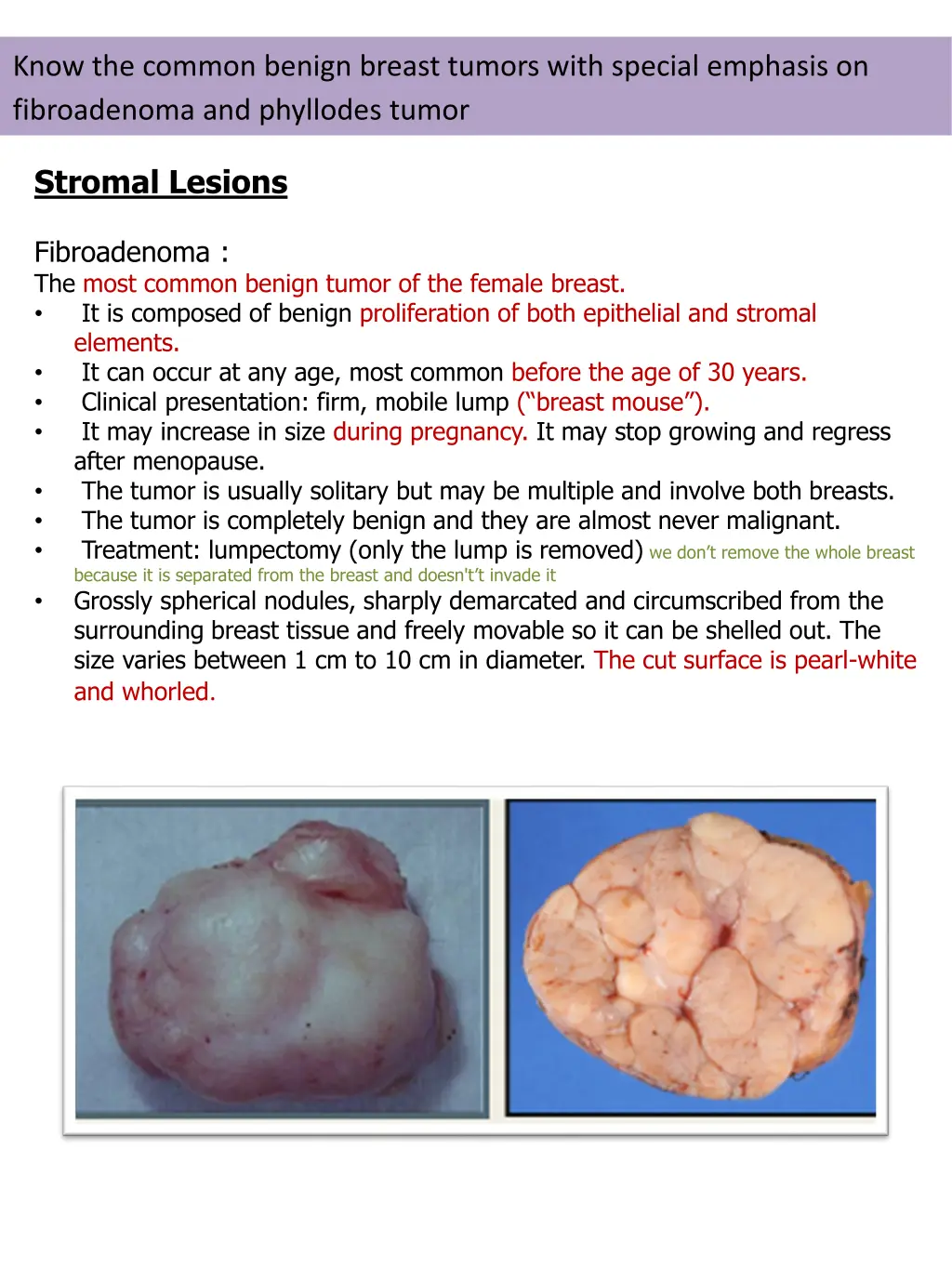 know the common benign breast tumors with special