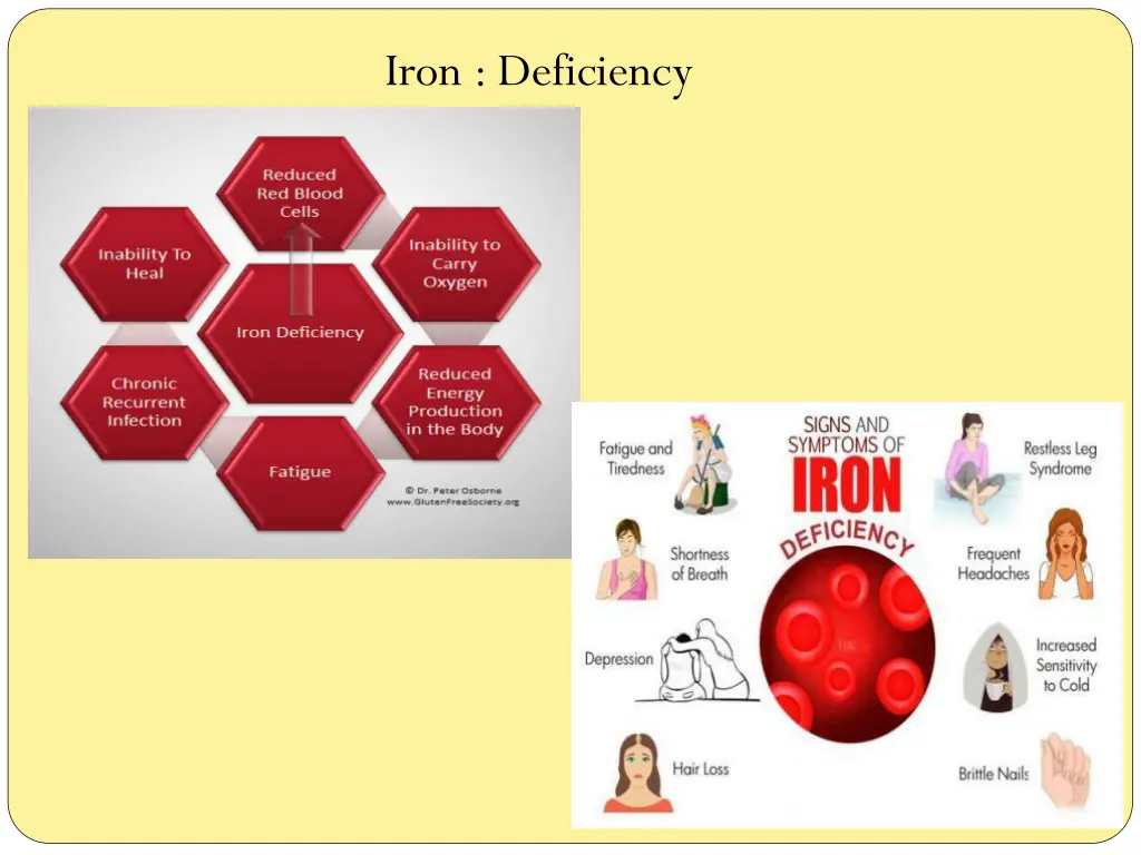 iron deficiency