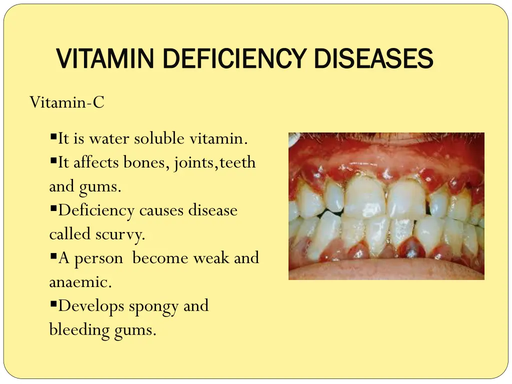 vitamin deficiency diseases vitamin deficiency