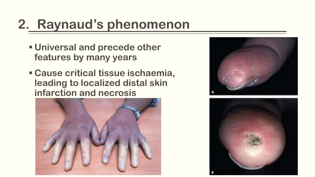 2 raynaud s phenomenon