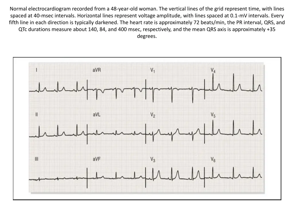 normal electrocardiogram recorded from a 48 year