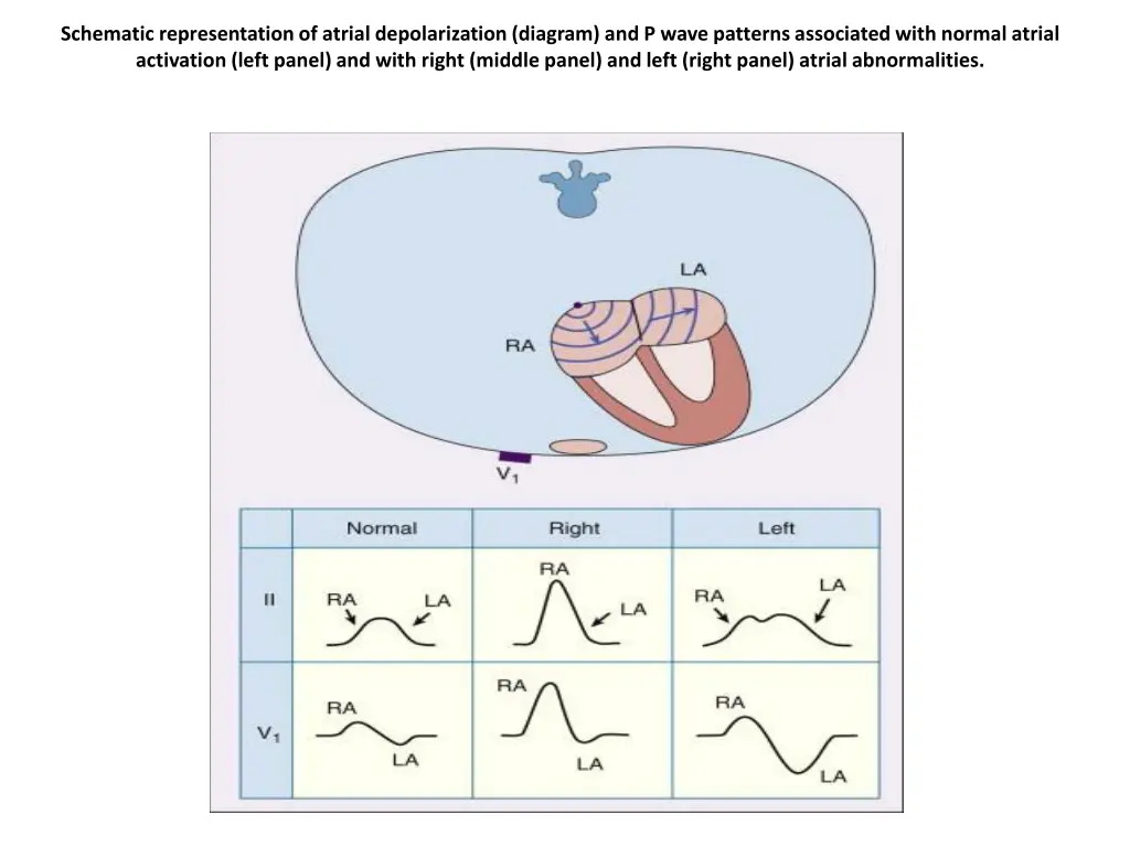 schematic representation of atrial depolarization