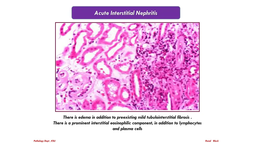 acute interstitial nephritis