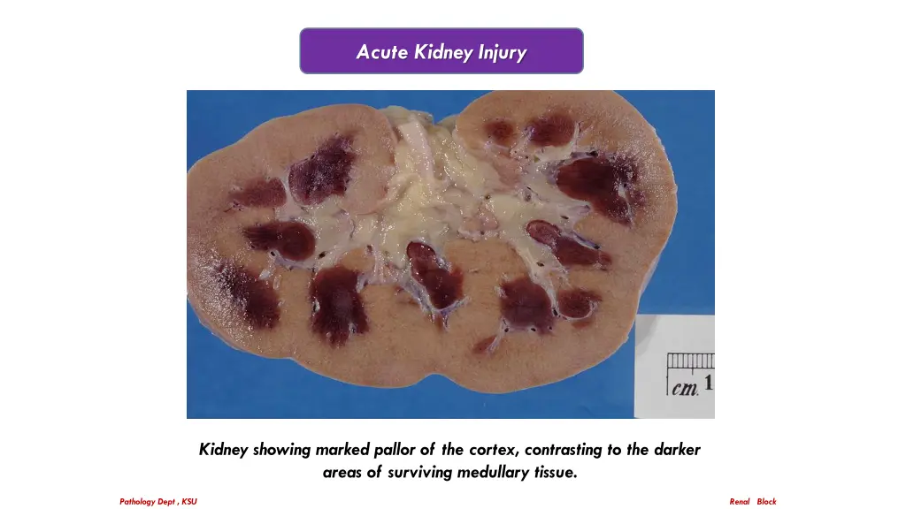 acute kidney injury 1