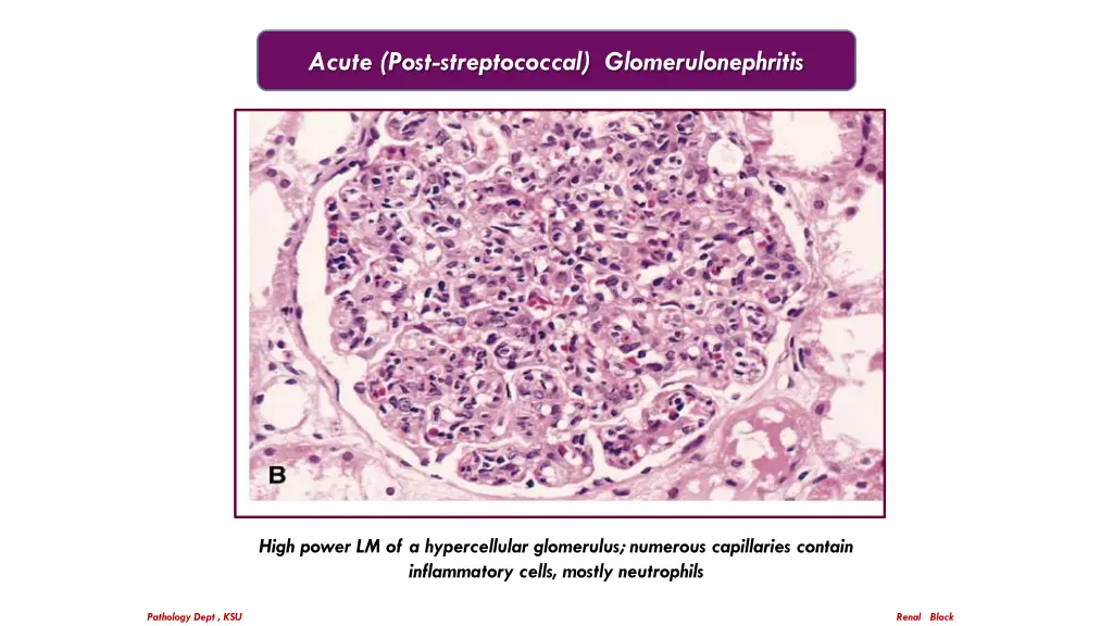 acute post streptococcal glomerulonephritis 2