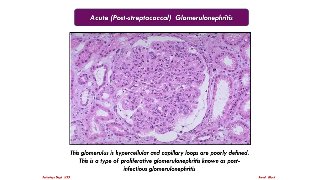 acute post streptococcal glomerulonephritis