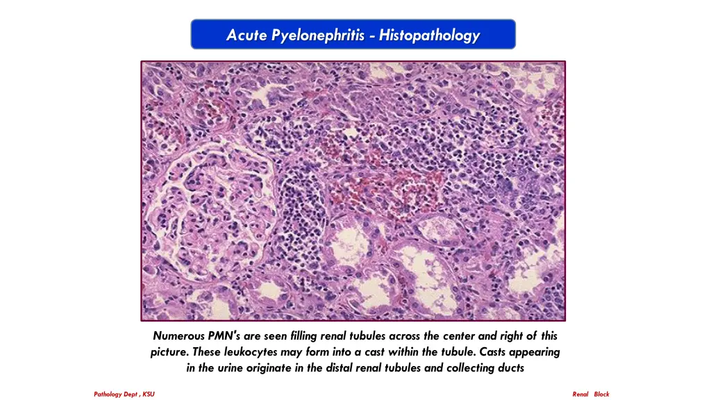 acute pyelonephritis histopathology 1