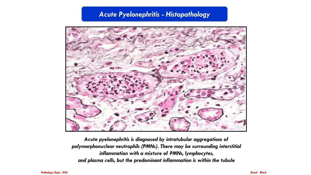 acute pyelonephritis histopathology