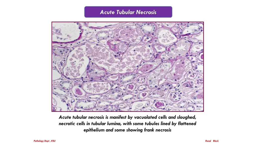 acute tubular necrosis