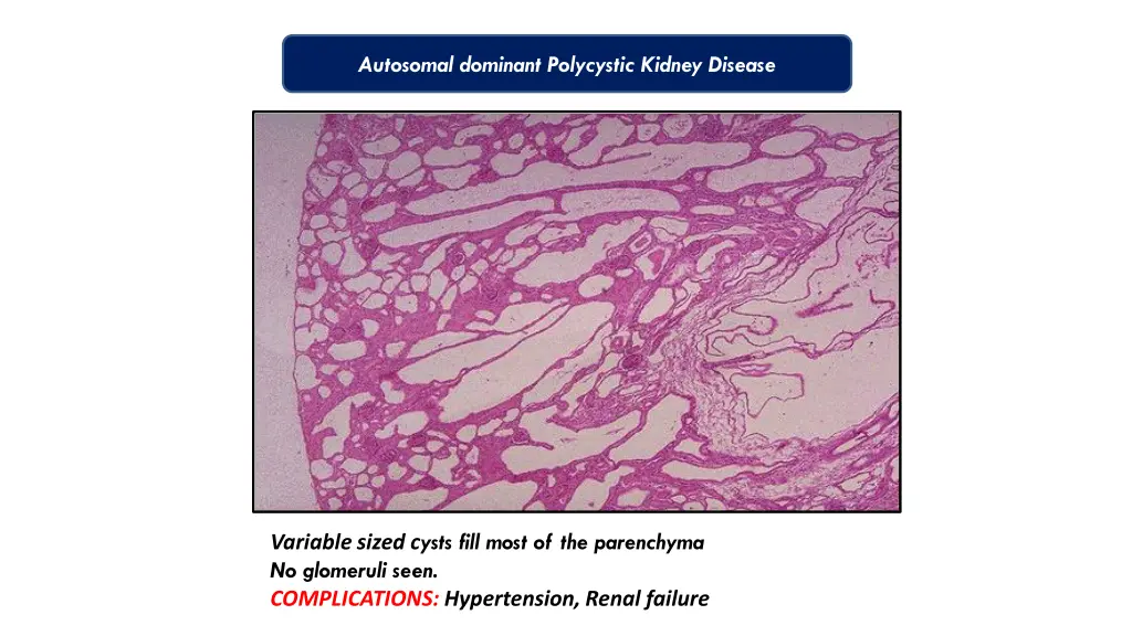 autosomal dominant polycystic kidney disease