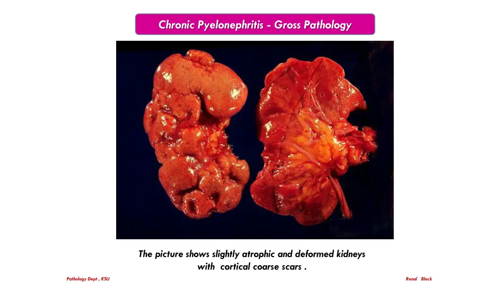 chronic pyelonephritis gross pathology