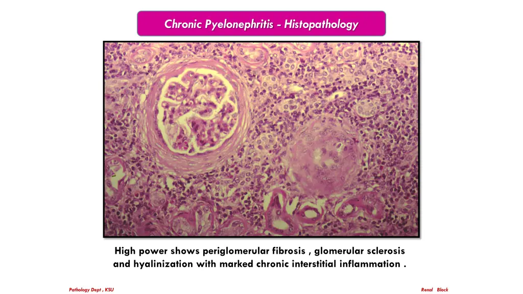 chronic pyelonephritis histopathology 1