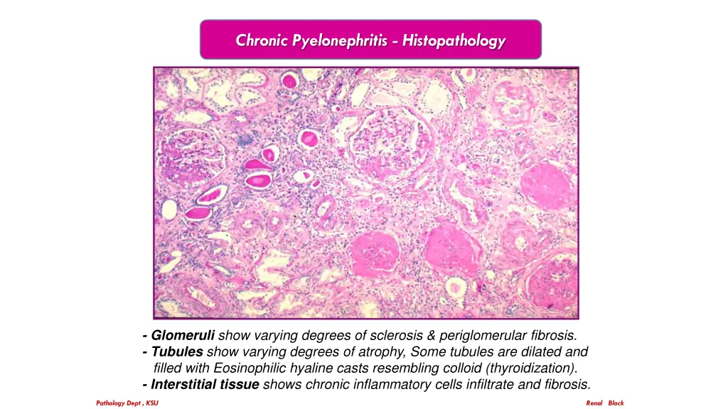 chronic pyelonephritis histopathology 2