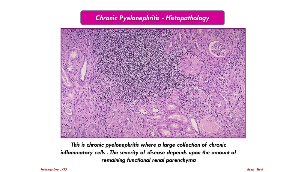 chronic pyelonephritis histopathology