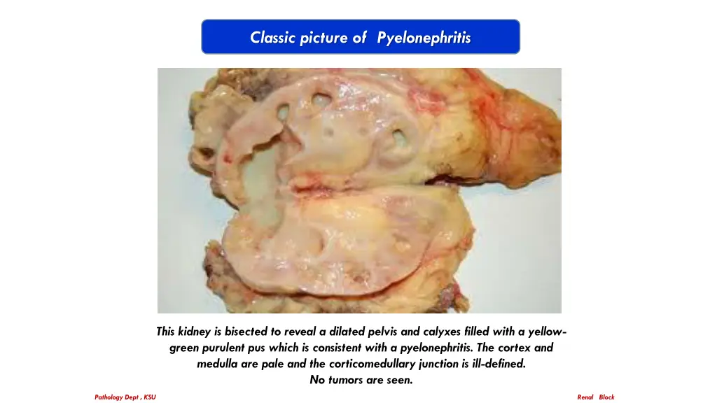 classic picture of pyelonephritis