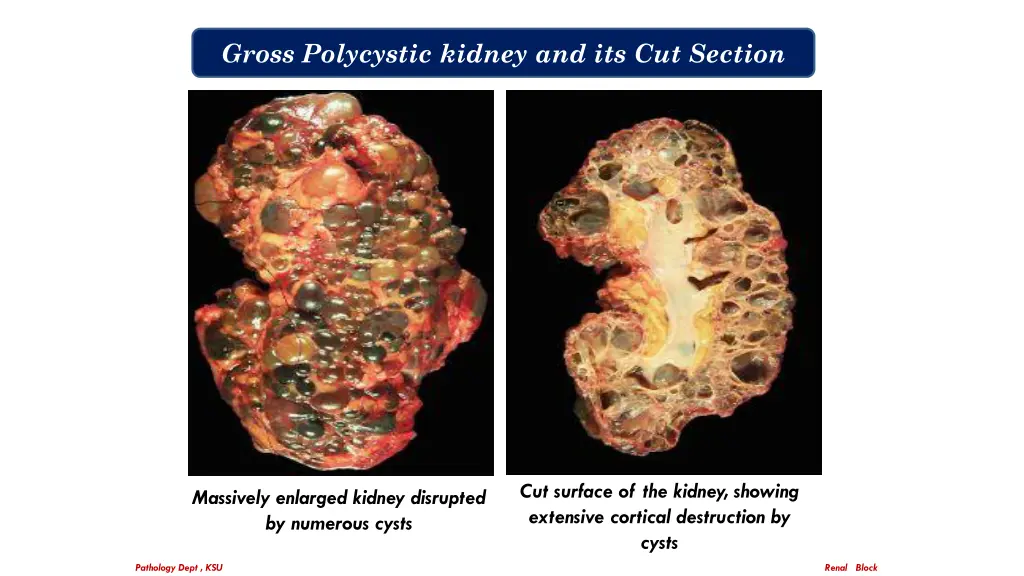 gross polycystic kidney and its cut section