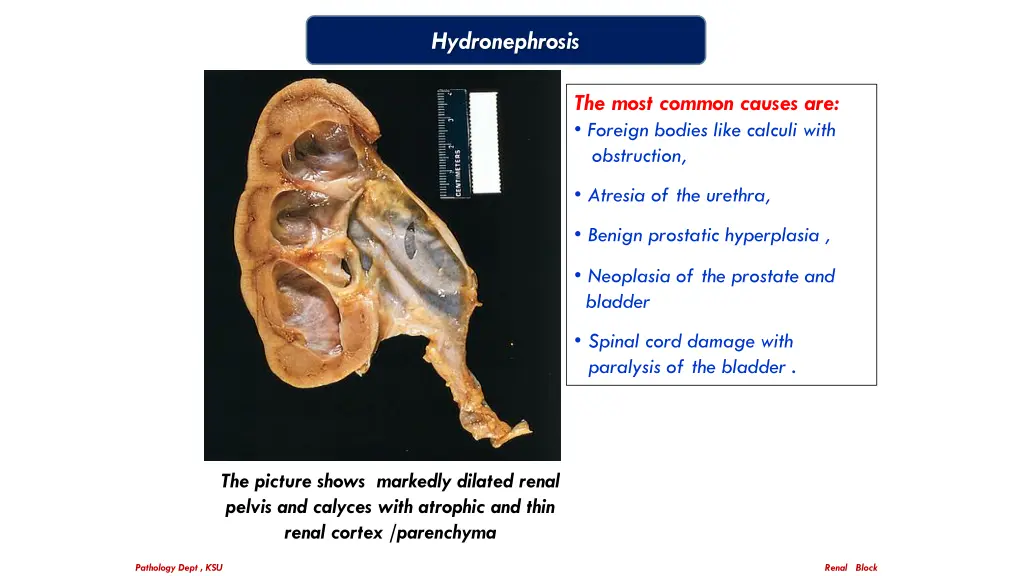 hydronephrosis 1