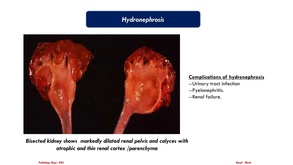 hydronephrosis 2