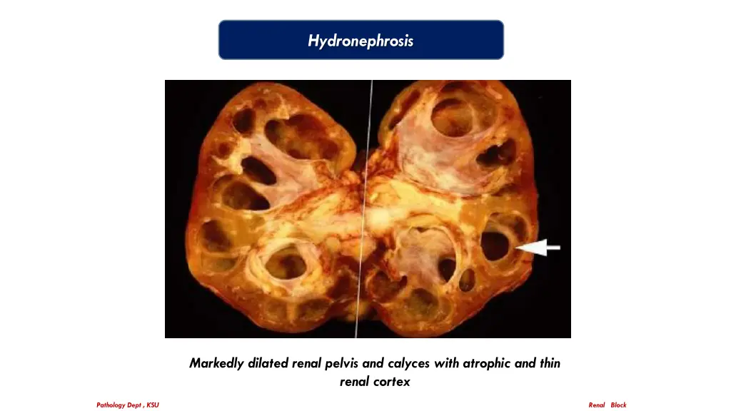 hydronephrosis 3