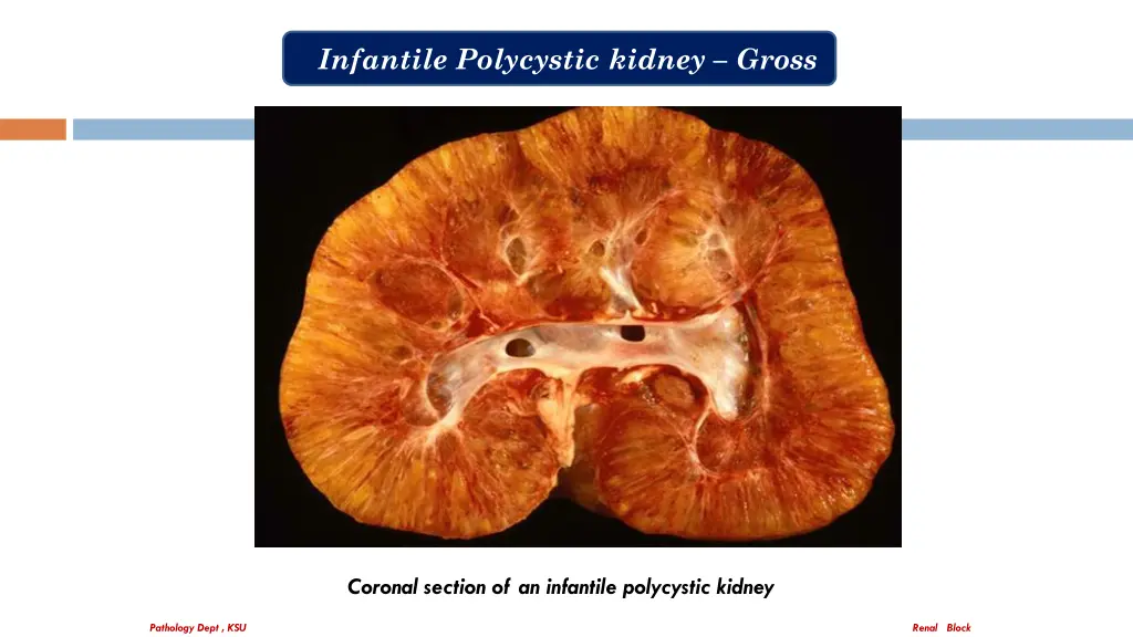 infantile polycystic kidney gross