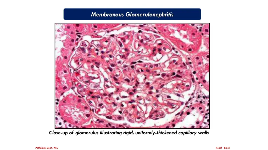 membranous glomerulonephritis 1