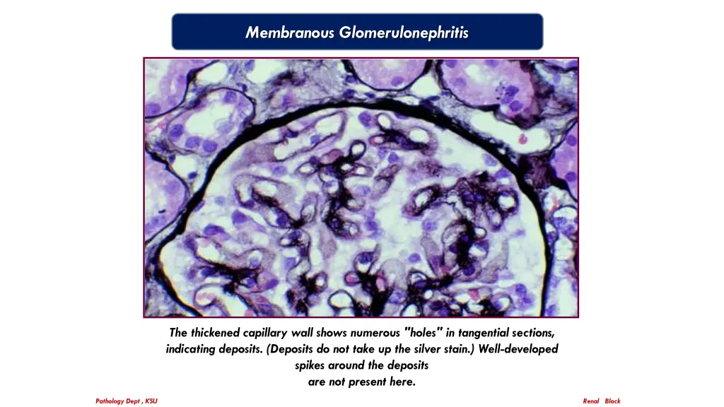 membranous glomerulonephritis 2