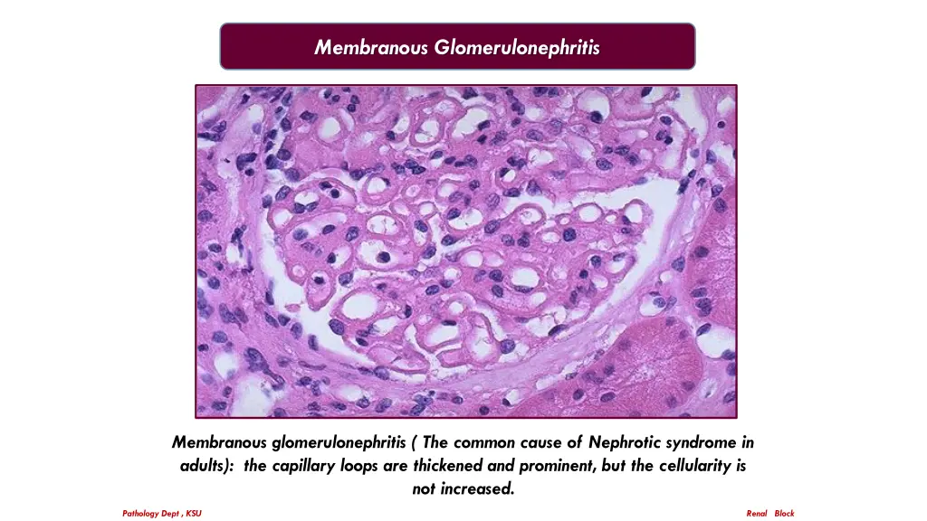 membranous glomerulonephritis