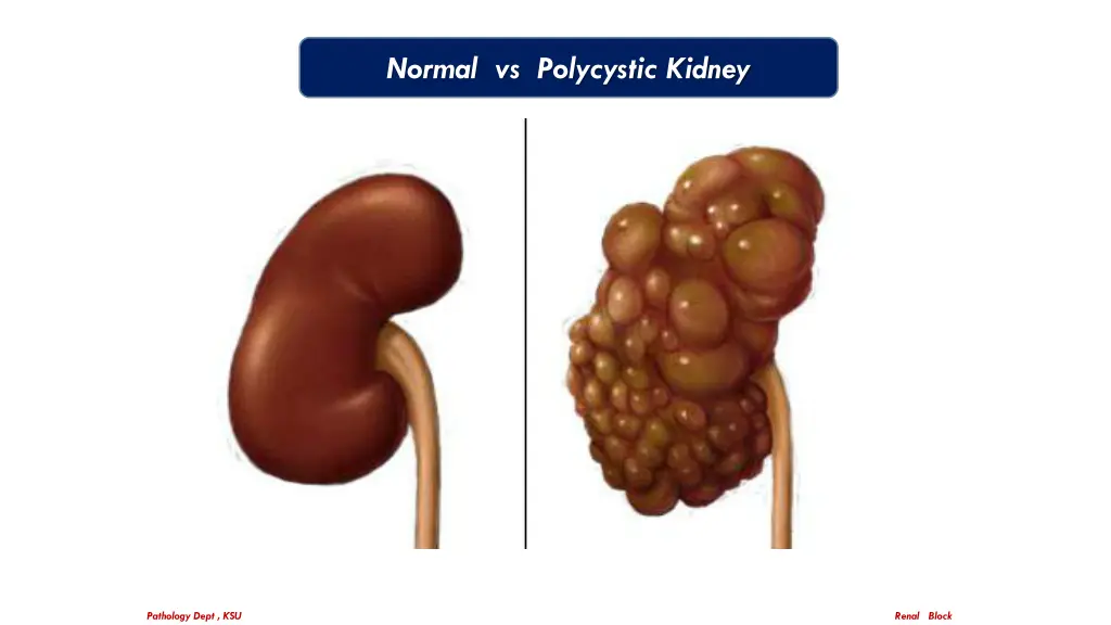 normal vs polycystic kidney