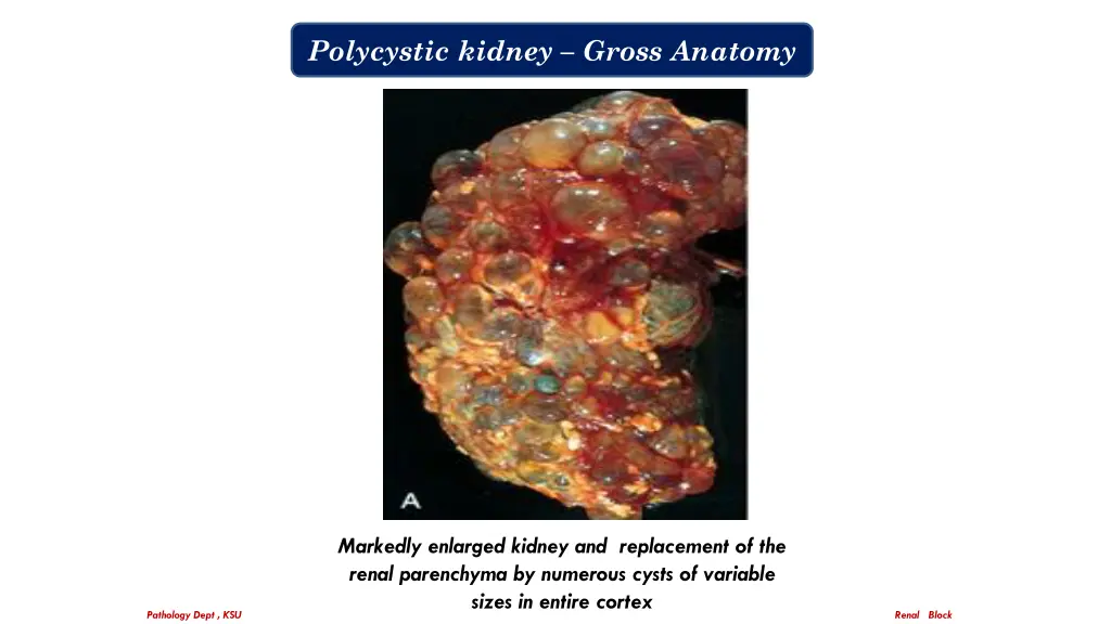 polycystic kidney gross anatomy