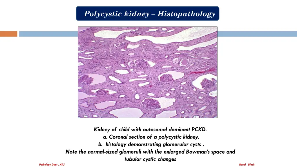 polycystic kidney histopathology