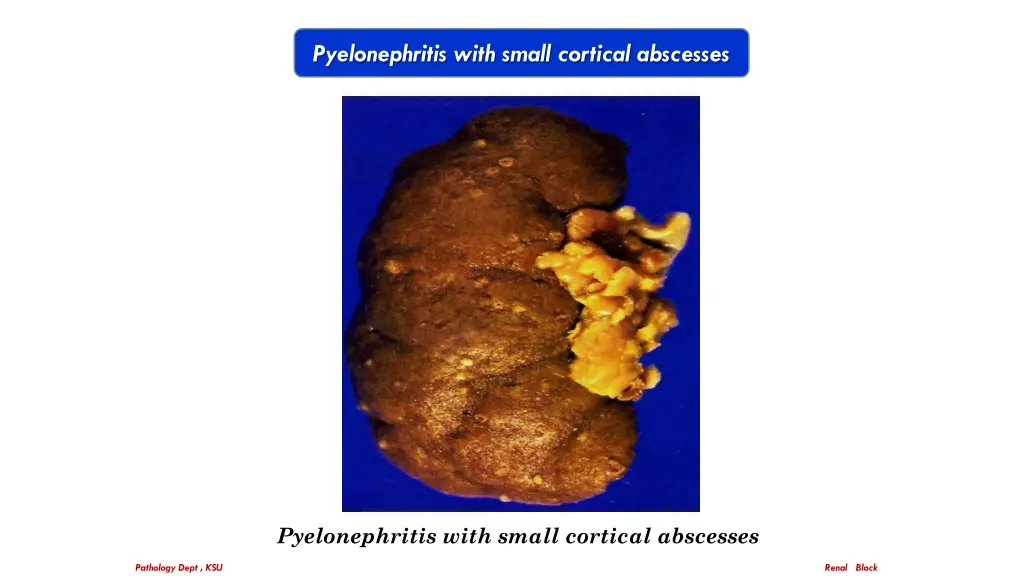 pyelonephritis with small cortical abscesses