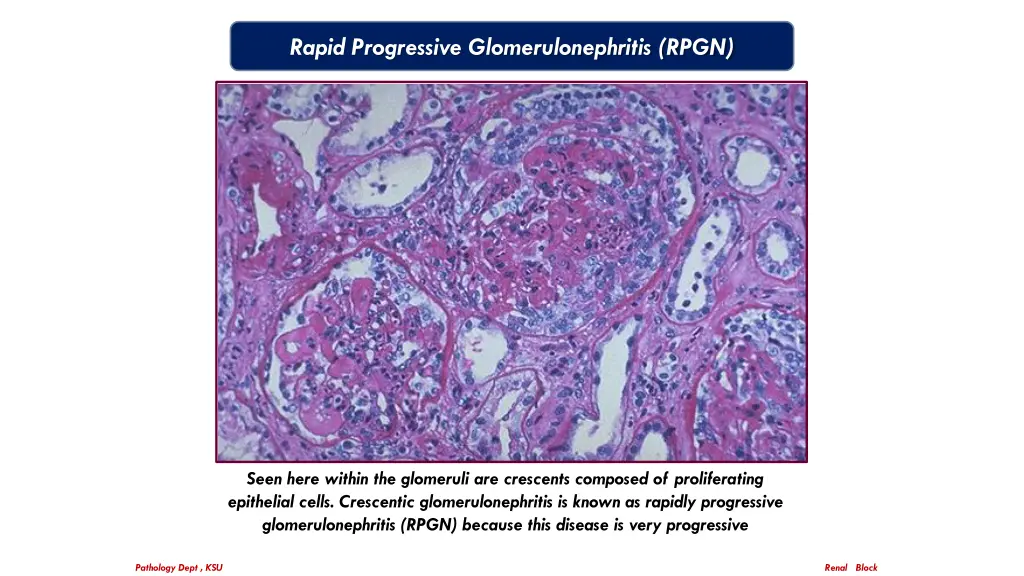 rapid progressive glomerulonephritis rpgn 1