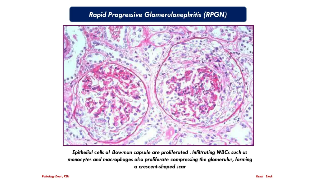 rapid progressive glomerulonephritis rpgn 2