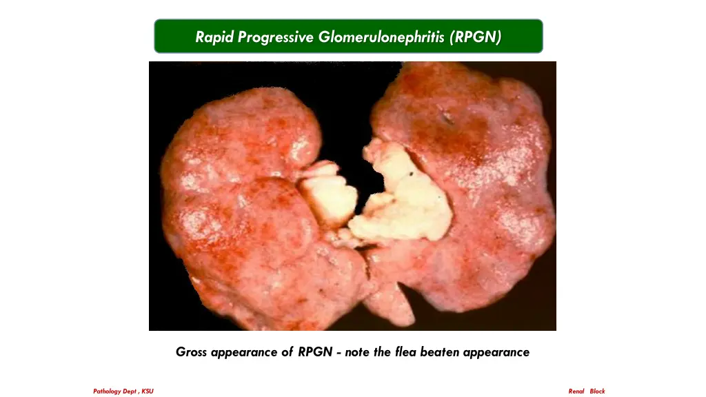 rapid progressive glomerulonephritis rpgn