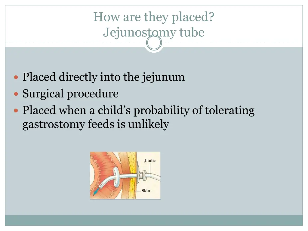 how are they placed jejunostomy tube