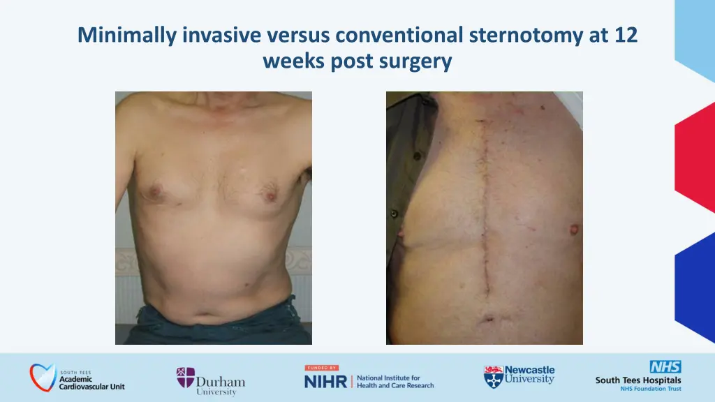 minimally invasive versus conventional sternotomy