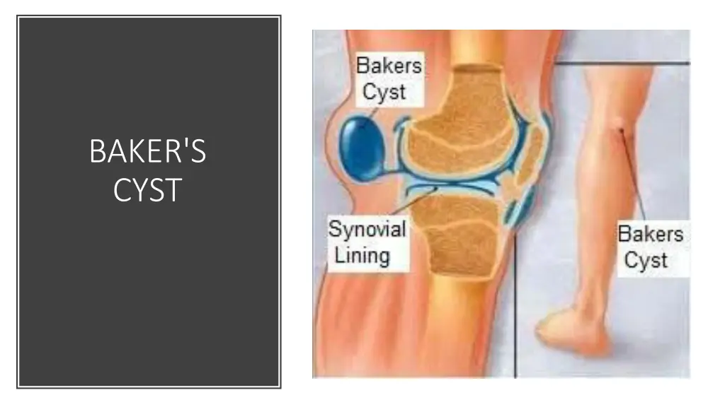 baker s cyst