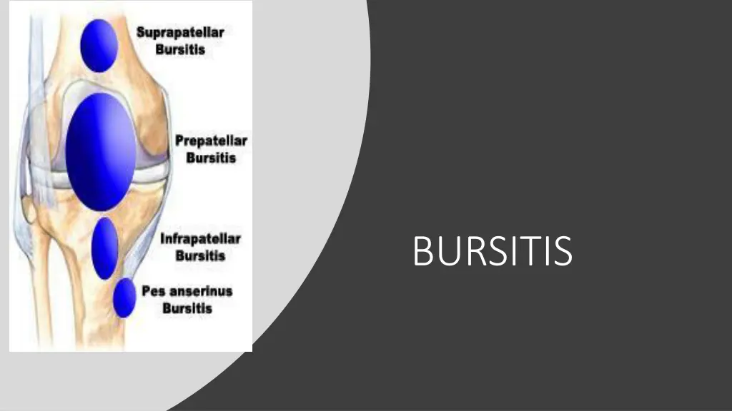 bursitis