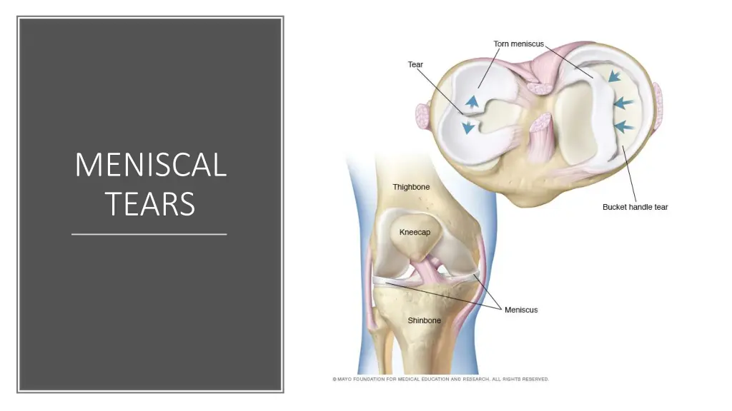 meniscal tears