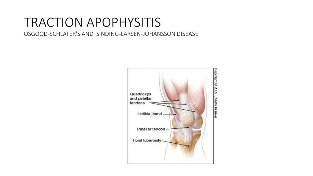 traction apophysitis osgood schlater