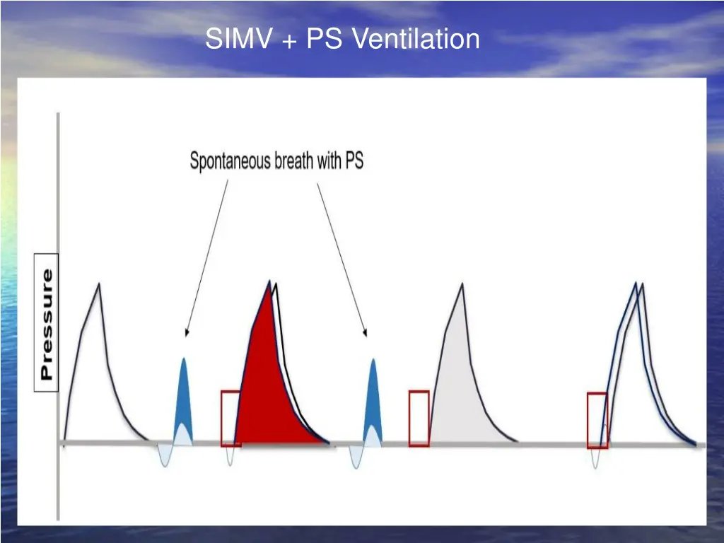 simv ps ventilation