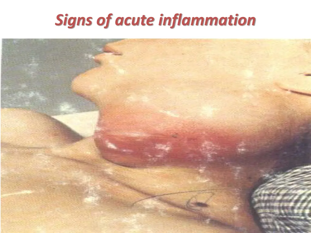 signs of acute inflammation