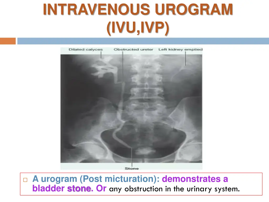 intravenous urogram ivu ivp