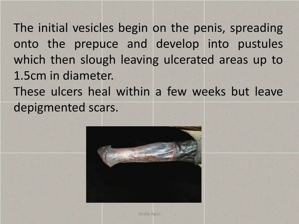 the initial vesicles begin on the penis spreading