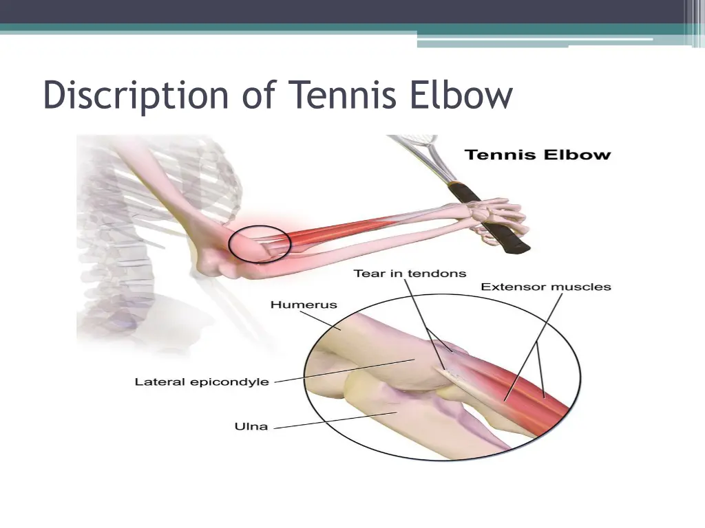 discription of tennis elbow