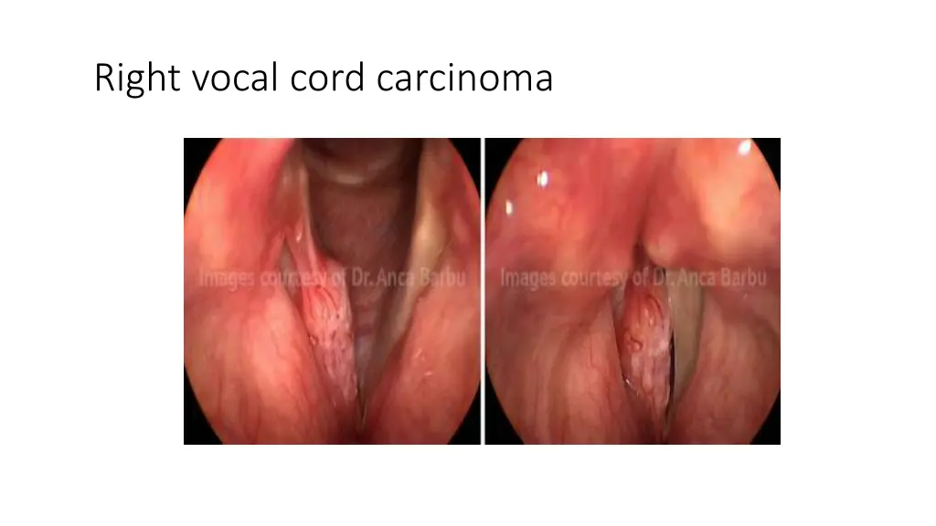 right vocal cord carcinoma